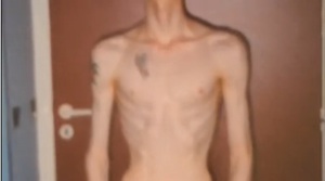 Anorexia: men too