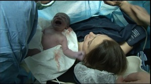 The Caesarian section boom